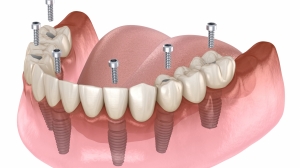 Zygomatic Dental Implants: Advancements In Full-Arch Restoration!